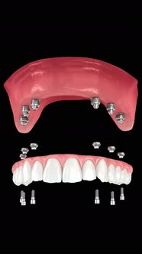 Dental prosthesis based on six implants. Dental 3D animation
