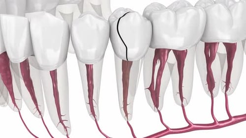 Dente rachado, partido. Animação 3D com precisão médica